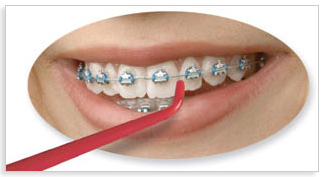 Great for Braces and Bridgework.